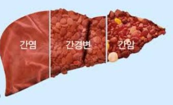 간경변 이미지