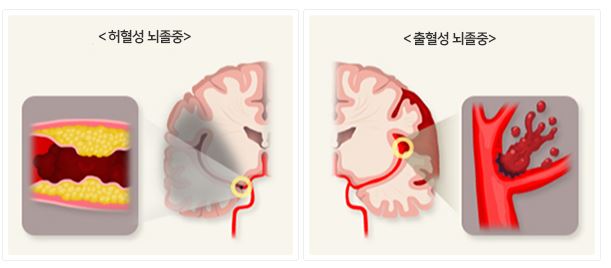 뇌졸중의 종류(질병관리청 국가건강정보포털(사진자료)