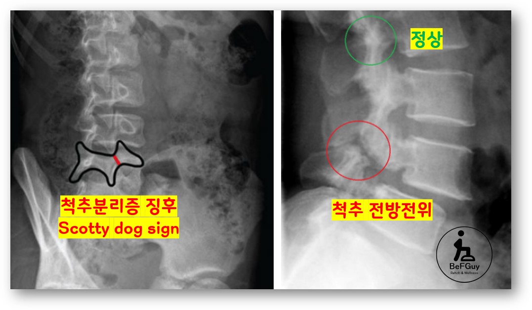 척추 분리증과 전방전위증 X-ray&#44; Scotty sign