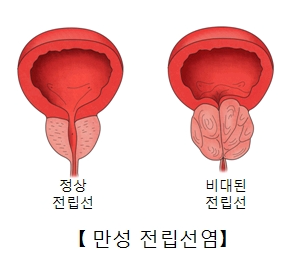만성 전립선염