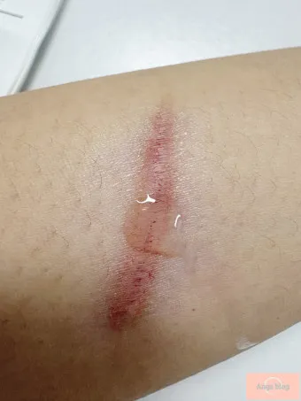 흉터전용 치료 추천 스카덤 겔 효능효과_20