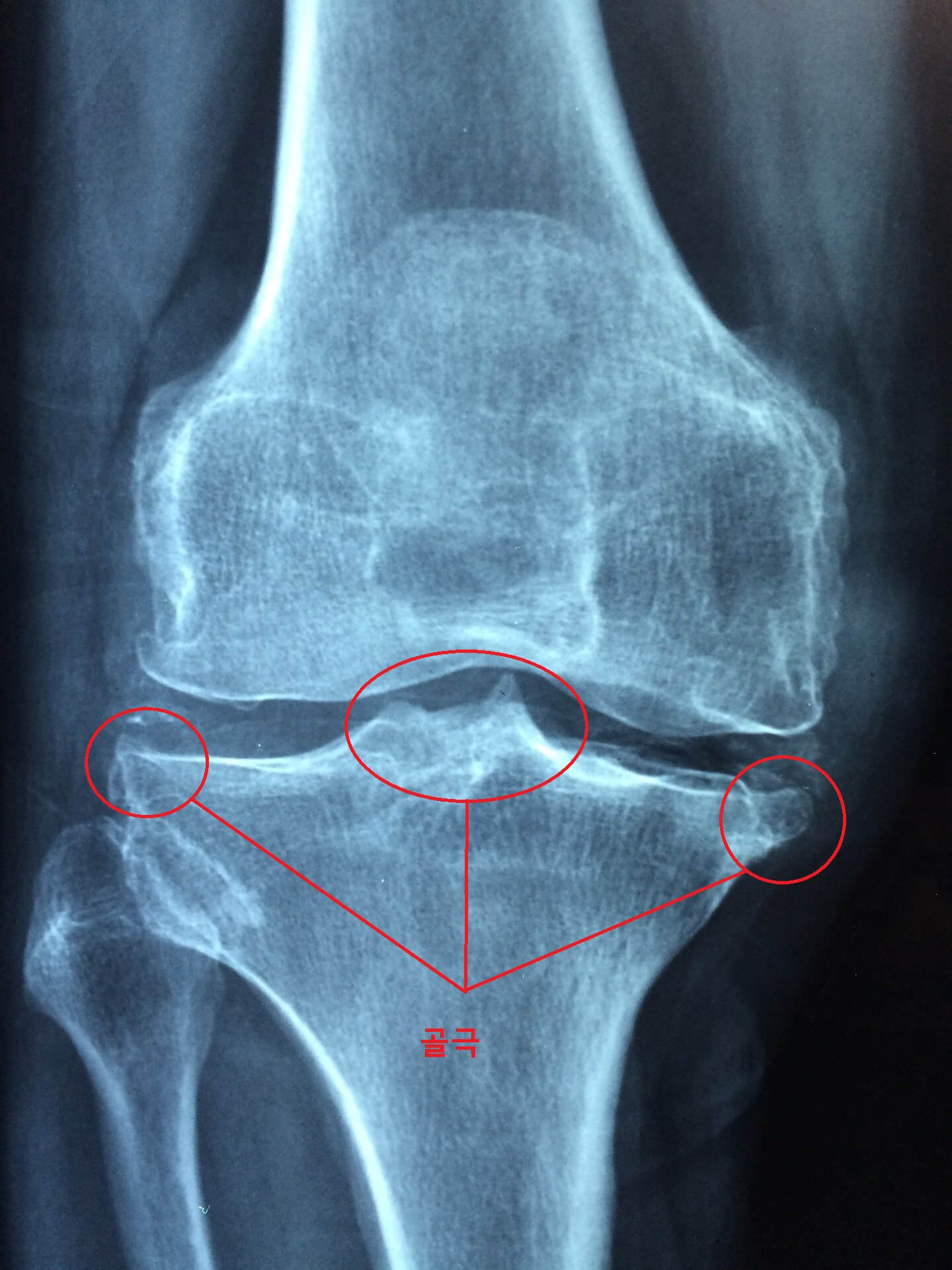 무릎에 관절염이 심해져서 골극이 생긴 것을 볼 수 있습니다. 