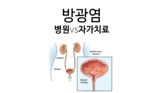 방광염 증상