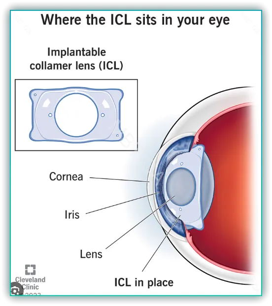 렌즈삽입술(ICL)