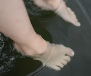 발톱무좀