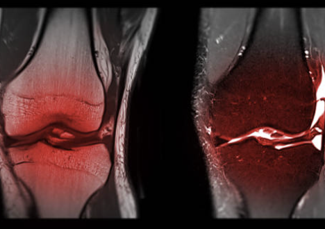 무릎 십자인대 파열 증상