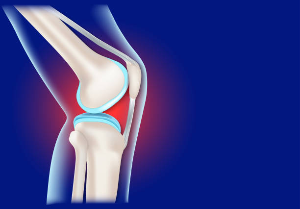 Running Trends May Be Ruining Your Knees: Understanding the Causes of Chondromalacia.
