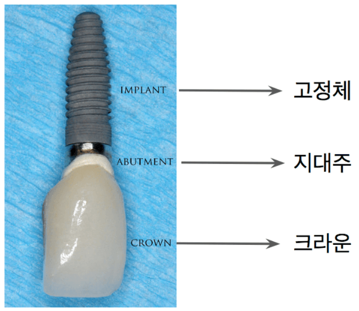 임플란트 가격비교 사이트 가격 저렴한곳