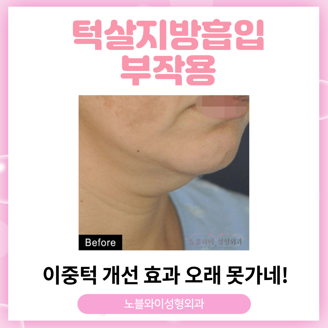 처진 턱살 빼는 턱지방흡입 후기 / 비용 및 부작용 정보