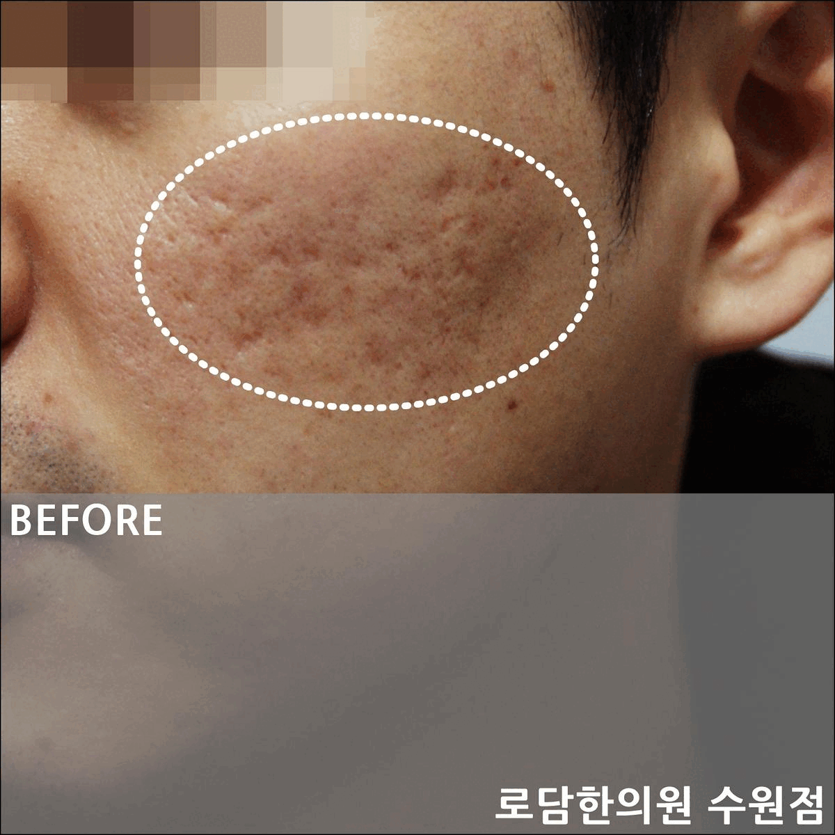  수원 여드름 흉터 패인 자국 치료 과정 한의원 새살침
