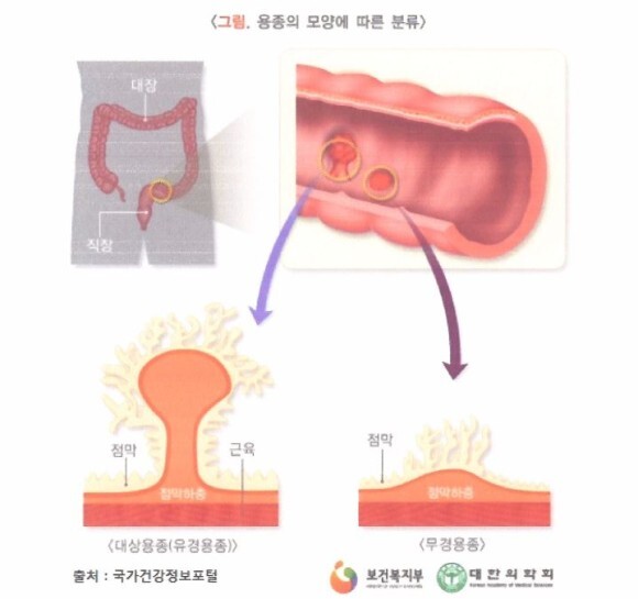  대장용종이 대장암이 되나요?!