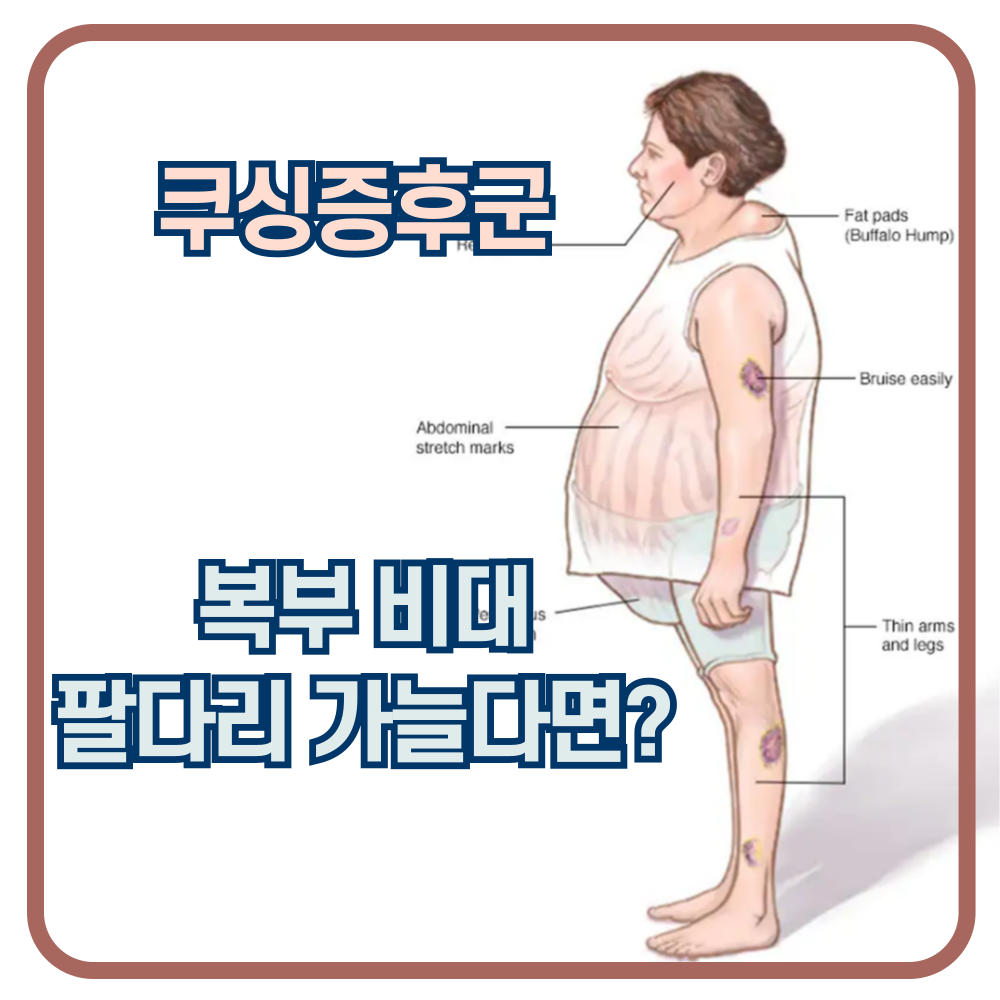 쿠싱 증후군. 얼굴과 복부는 비대&#44; 팔다리는 가늘다면 의심!!