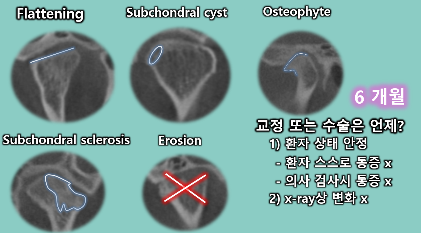 턱 퇴행성 관절염 치료법과 턱관절 스플린트 3종류 비교