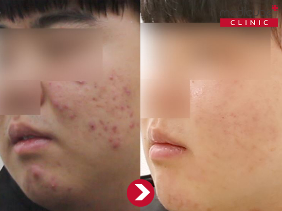  신논현피부과 메디큐브클리닉 여드름치료 전후사진 대공개