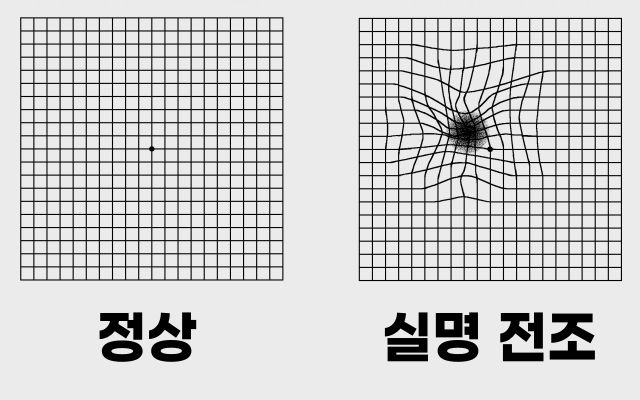 실명 전조증상 5, 선이 휘어져 보여요, 팁줌