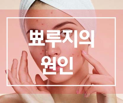  뾰루지의 원인의 되는 9가지 생활습관