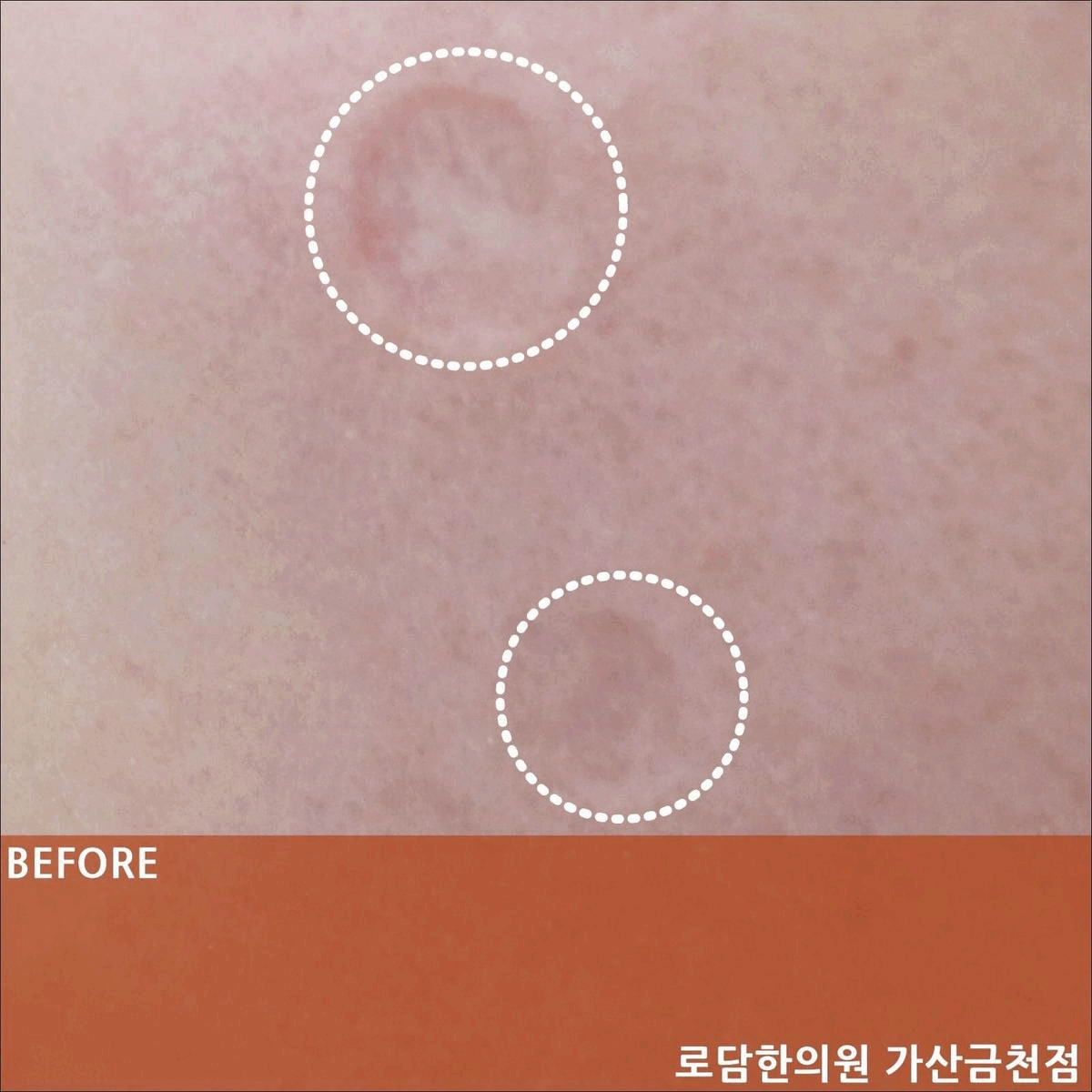  긁힌 상처 자국 파인 흉터 치료 과정 새살침 코라테라피