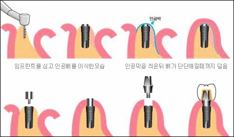 임플란트 수술 방법 종류