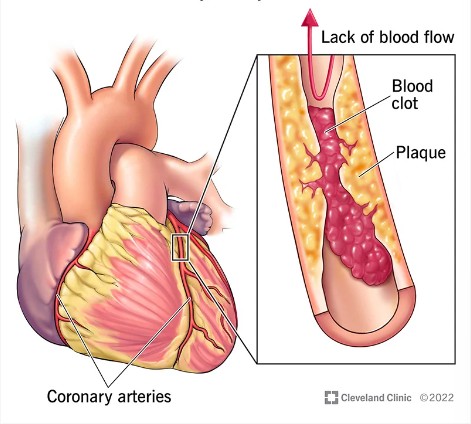 관상동맥 질환 Coronary artery disease