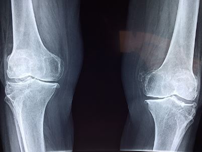 무릎 인공 관절 수술 비용 지원 사업-연골 마모