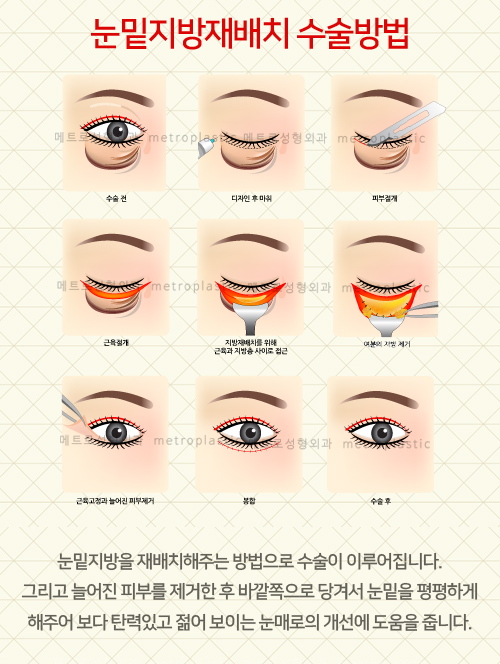 눈밑지방 재배치 수술비용 수술방법의 차이 12