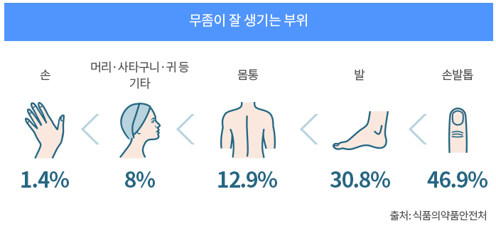 무좀-생기는부위