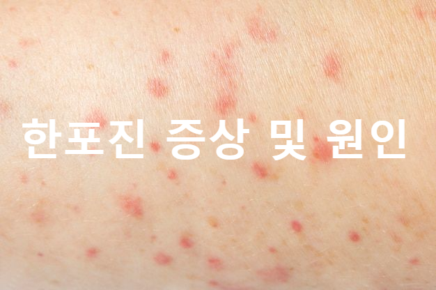  한포진 증상 원인 치료 전염 어떻게 해야할까?