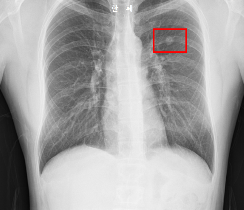 폐결절 고화질 사진