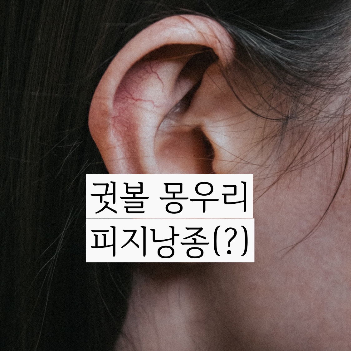  귓볼 몽우리 통증 피지낭종 미리 예방하기 귓볼 멍울 조치