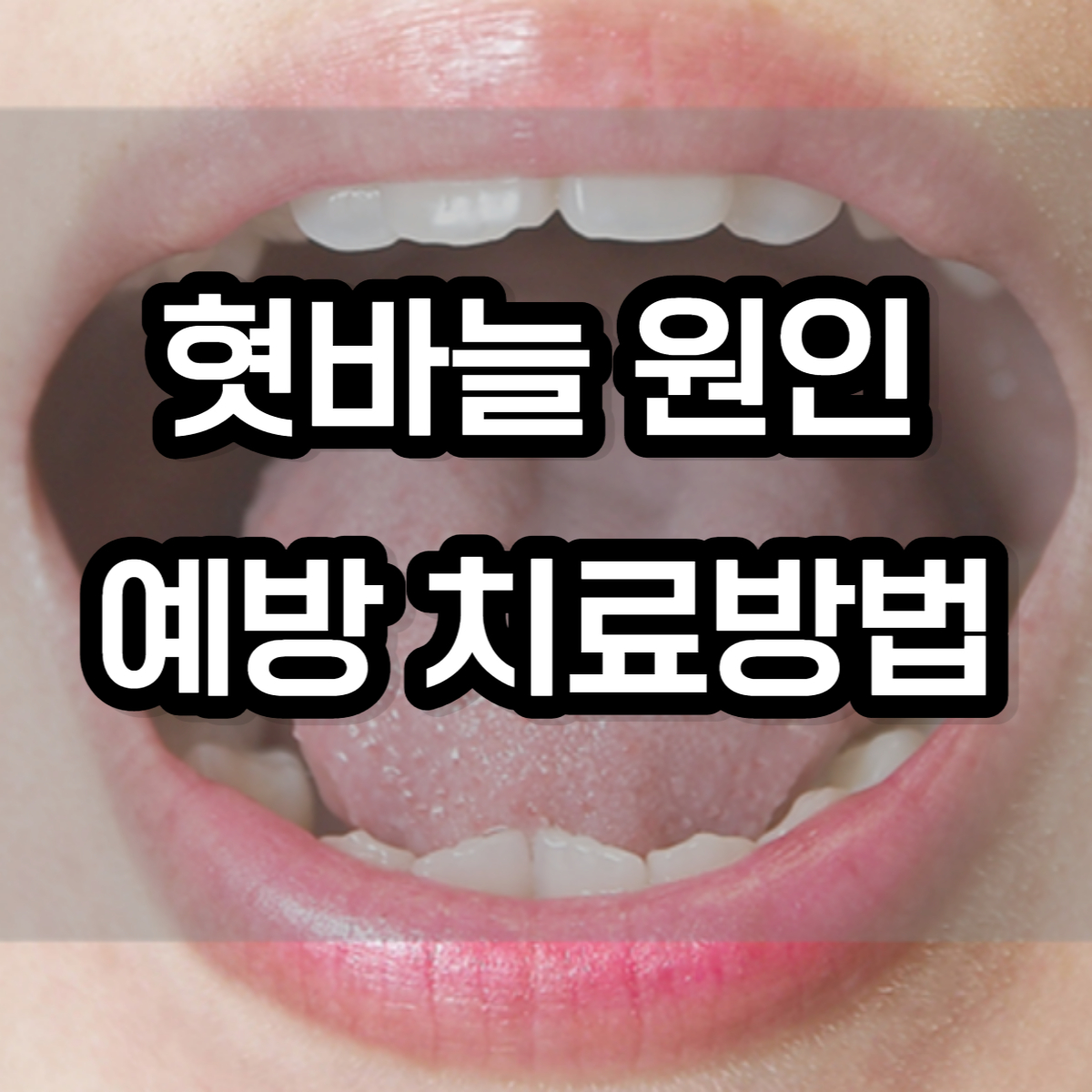 혓바늘 원인 예방 치료방법