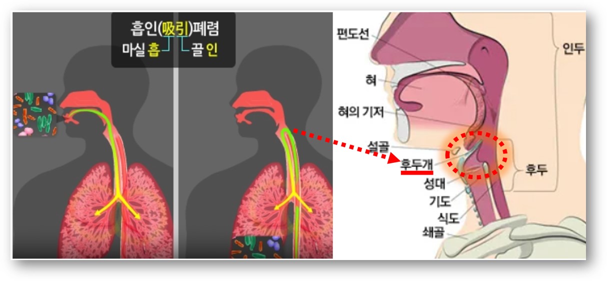 흡인성 폐렴(Aspiration pneumonia)