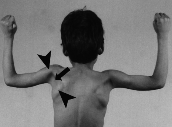 Posterior axillary depression sign
