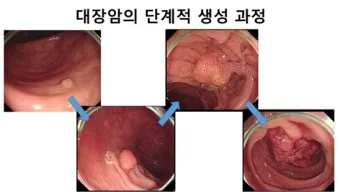 대장내시경 당일식사 주의사항 피해야 하는 음식_5