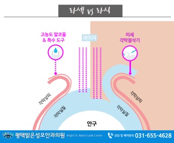  라식 라섹 차이는?