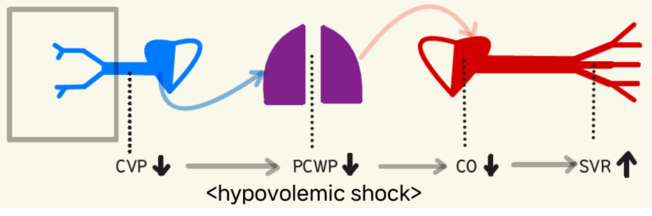 hypovolemic shock