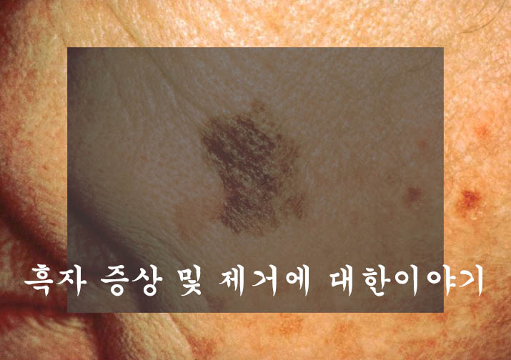  흑자 원인, 증상, 치료(제거)방법 및 예방, 좋은음식 한눈에 정리