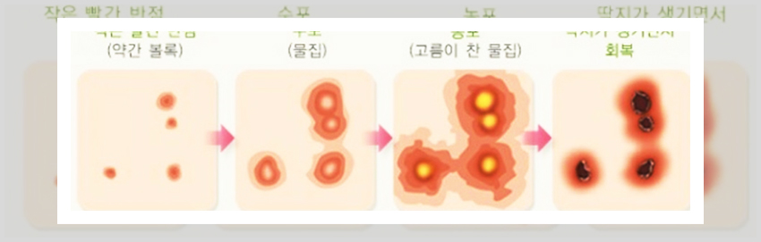 대상포진 4가지 증상들로 발열, 붉은 발진, 가려움, 수포의 이미지