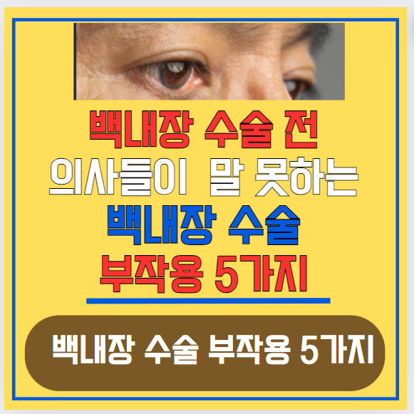 백내장 수술 전 의사들이 말 못하는 백내장 수술 부작용 5가지