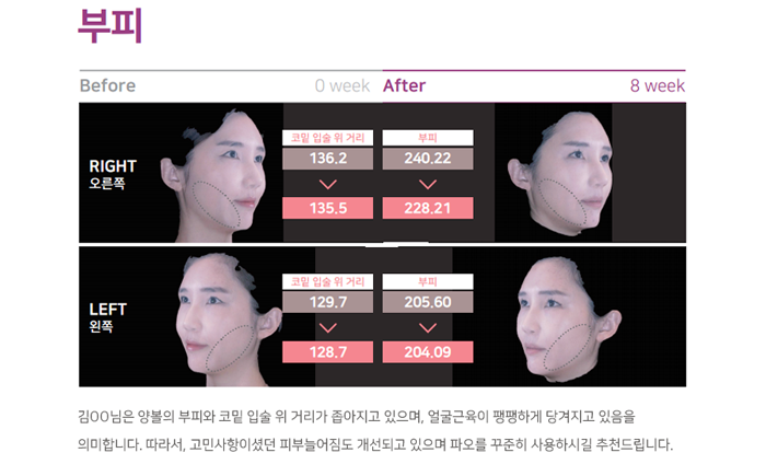 입가주름 1