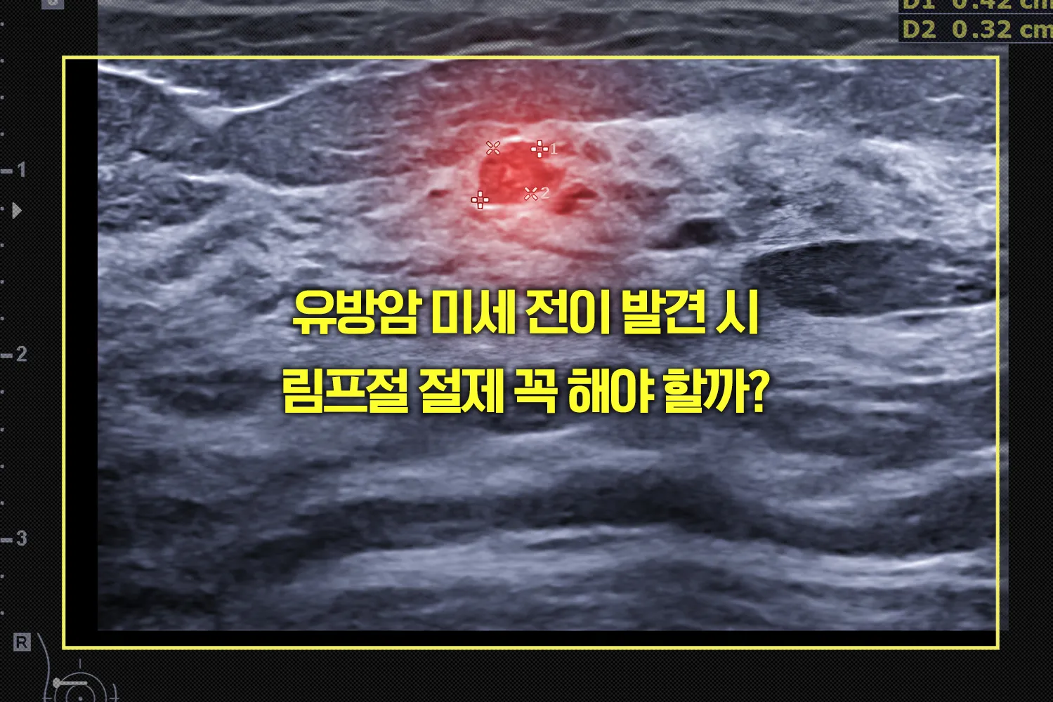 유방암 미세 전이 발견 시 림프절 절제 여부