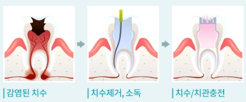 신경치료 및 가격 안내