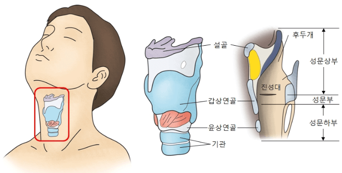 후두암