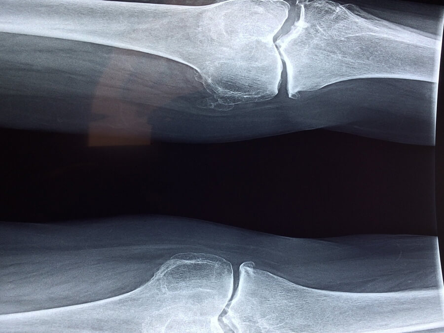 관절부위-엑스레이