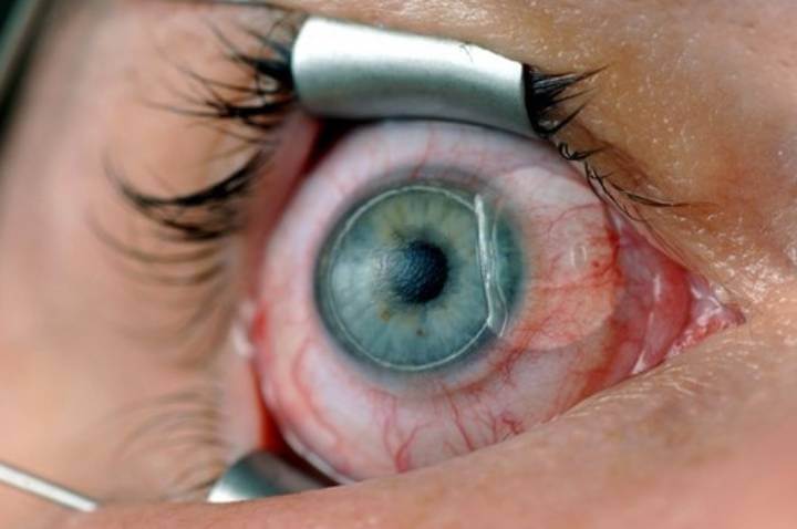 라식 수술 중 각막절편을 만들고 들어 올리는 장면