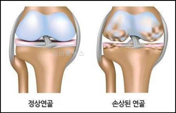 연골-관절-건강-개선-효능