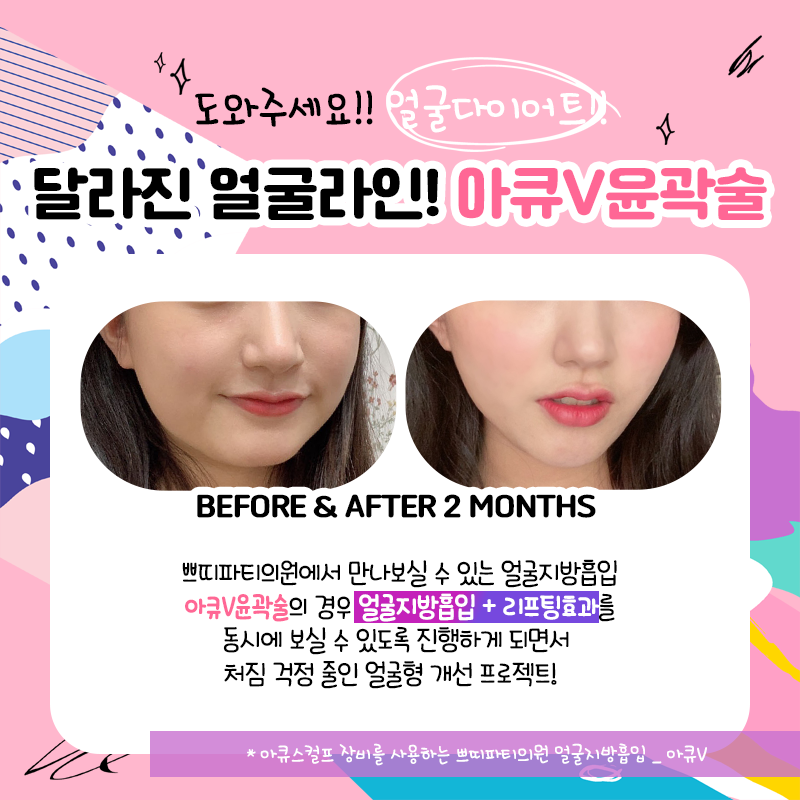 아큐리프트 이중턱 지방흡입으로 나만의 V라인을 찾아보세요! (+가격 이벤트) 4