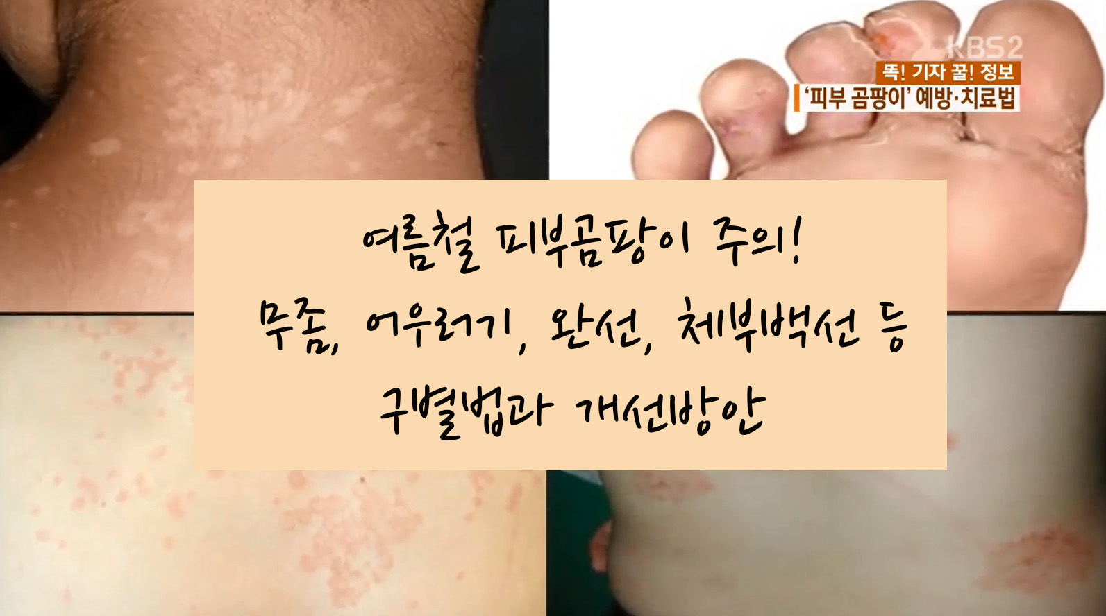 피부곰팡이균의 증상, 종류 및 치료방법 8