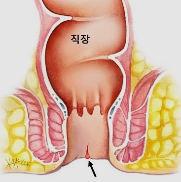  치질 치핵 증상 및 원인 치료방법, 합병증