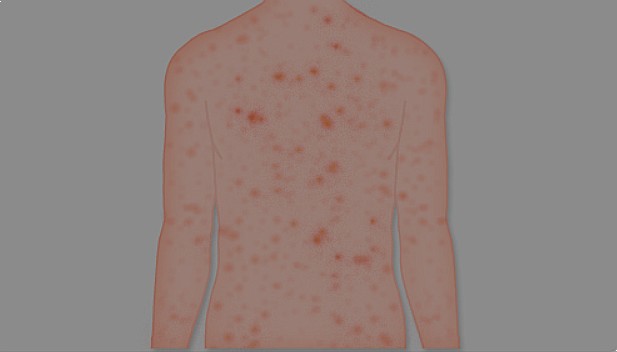  풍진(Rubella, German measles)