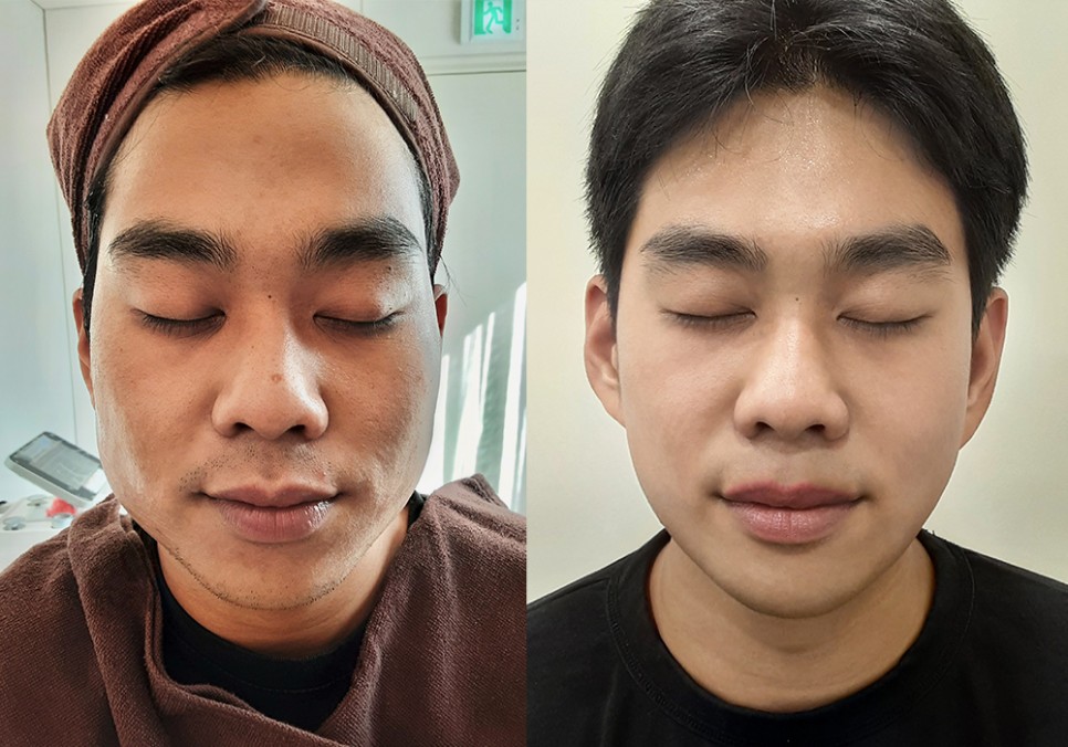  남자 리프팅, 이것 만큼은 반드시 체크해주세요